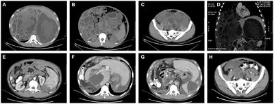 Multiple cystic echinococcosis in abdominal and pelvic cavity treated by surgery with a 4-year follow-up: a case report